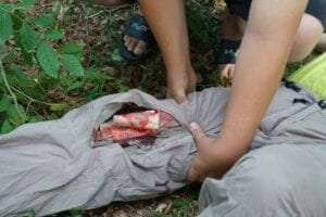 Open Fracture First Aid
